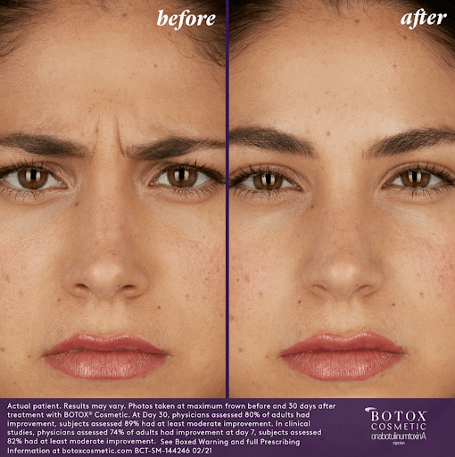 A woman before and after botox treatment.