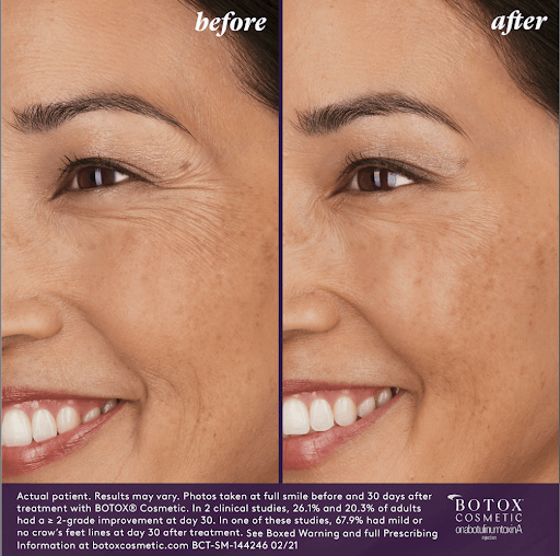 A woman 's face before and after botox treatment.