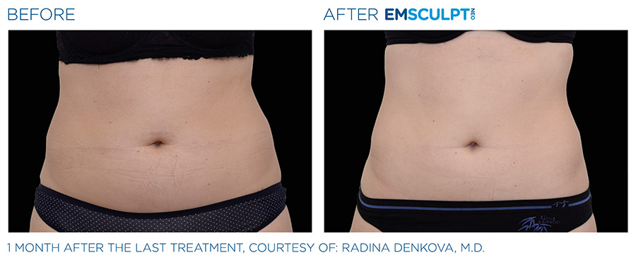 A woman 's stomach before and after emsculpt.