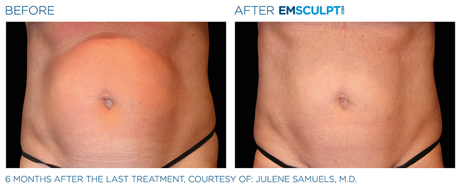 A before and after picture of an emsculpt treatment.