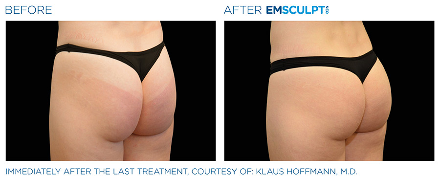 A before and after picture of an emsculpt treatment.