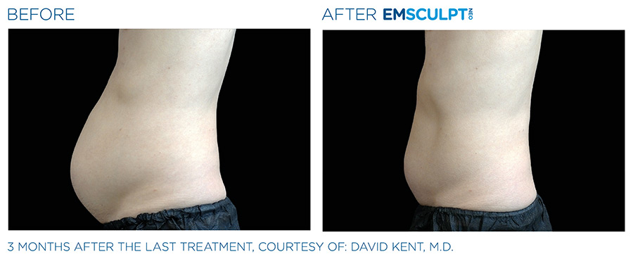 A man with no shirt is shown before and after emsculpt.