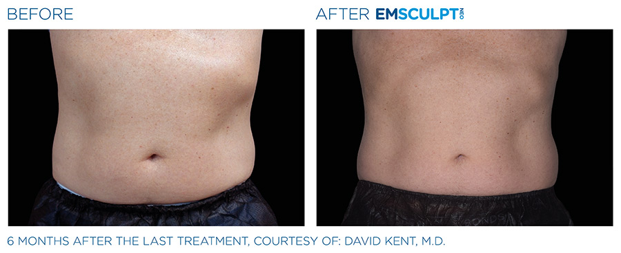 A before and after picture of an emsculpt treatment.