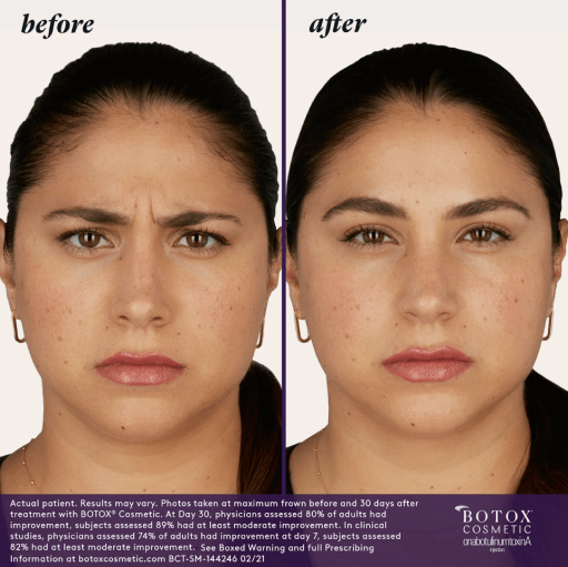 A woman before and after botox treatment.