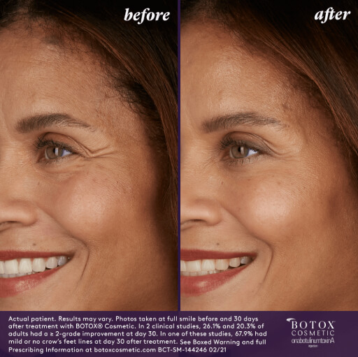 A woman before and after botox treatment.